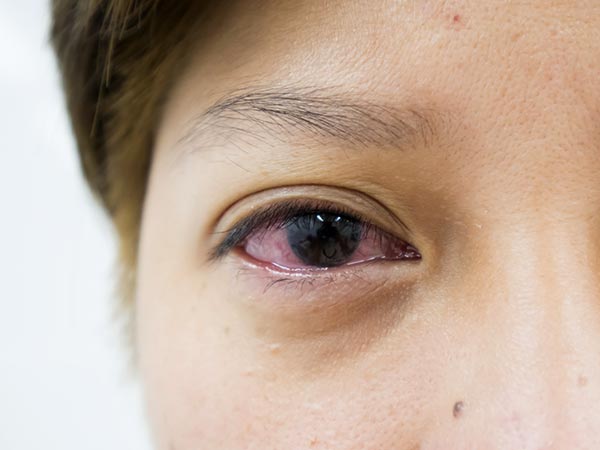 COMMON EYE PROBLEMS (സാധാരണ നേത്ര പ്രശ്നങ്ങൾ)| KPSC & HCA Study Material_50.1