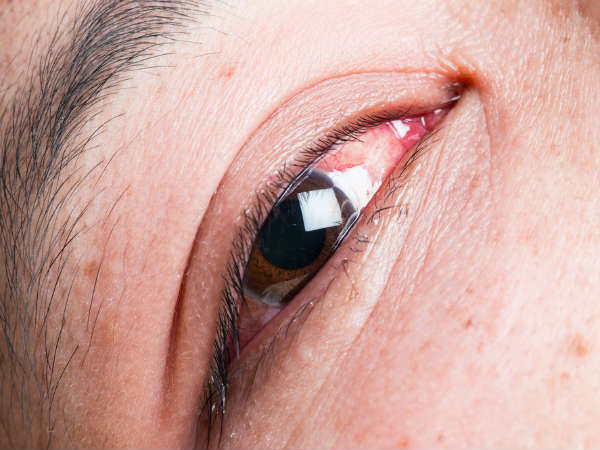 COMMON EYE PROBLEMS (സാധാരണ നേത്ര പ്രശ്നങ്ങൾ)| KPSC & HCA Study Material_100.1