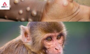 First Case of monkeypox in the Gulf reported in the UAE